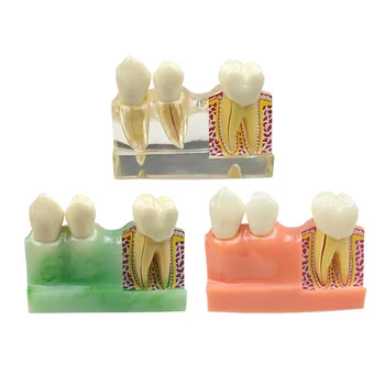 Модель для разборки кариеса, модель зубов, исследование стоматолога, обучающие стоматологические материалы, 1 шт.